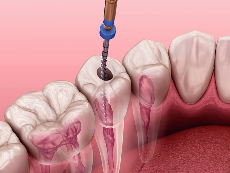 endodontia