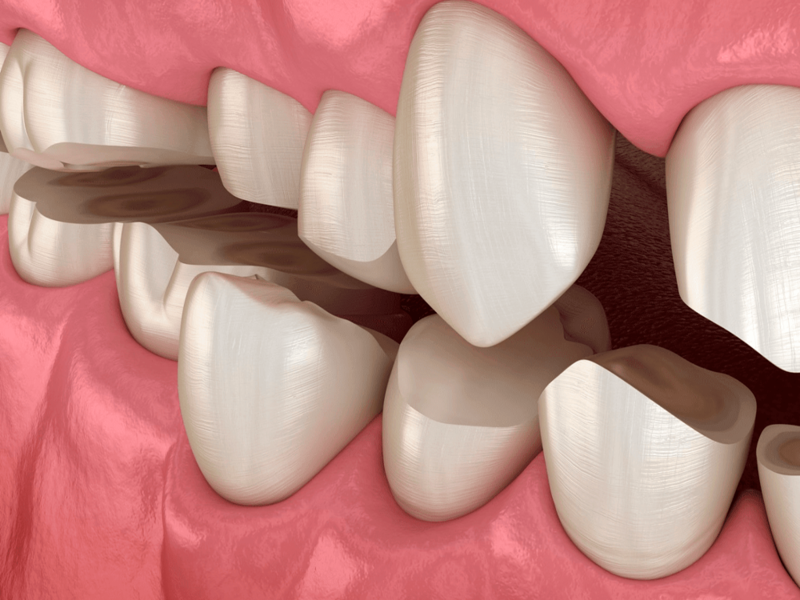 disfuncao-temporo-mandibular-dtm-oclusao