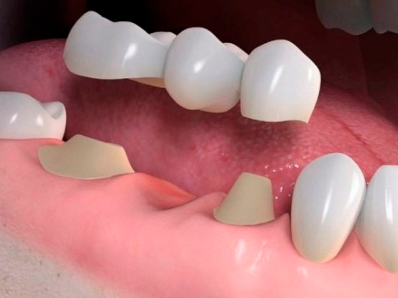 implantes-para-perda-de-todos-os-dentes