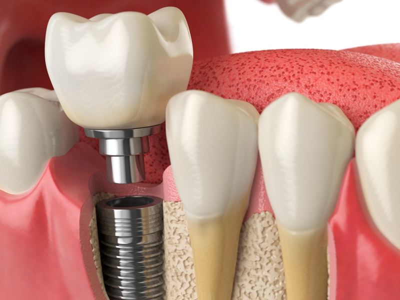 implantes-para-perda-de-um-dente