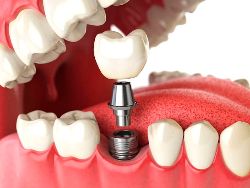 implantes-para-perda-de-alguns-dentes